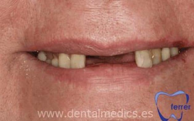 Antes