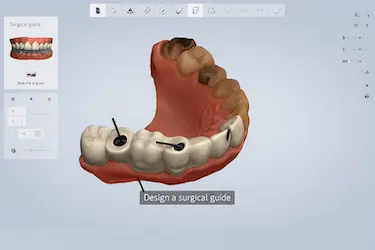 Cirugía de implantes dentales mínimamente invasiva en la Clínica Dental Dr. Ferrer en Murcia