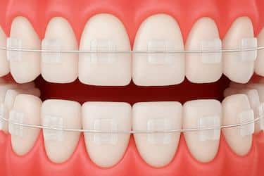 Ortodoncia con brackets de zafiro o circonio en Madrid en Clínica Dental Dr. Ferrer