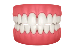Dientes con diastema antes de ortodoncia en Madrid