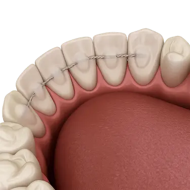 Retenedor fijo lingual colocado en la cara interna de los dientes tras un tratamiento de ortodoncia