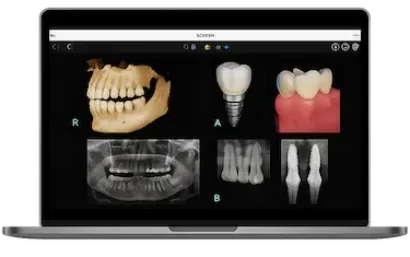Estudio radiológico digital para valorar el hueso previo a una elevación de seno maxilar