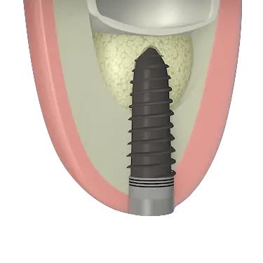 Ilustración 3D de la colocación de un implante dental tras elevación de seno maxilar