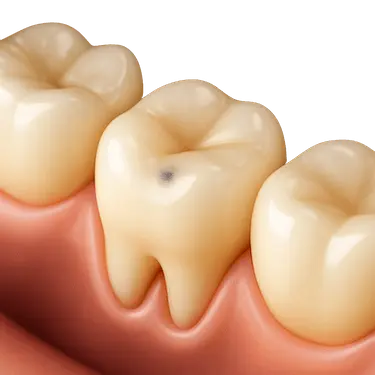 Caries leve en una muela tratada con empaste dental pequeño para proteger el diente