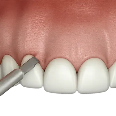 Representación 3D del primer paso del alargamiento de corona dental con eliminación de encía