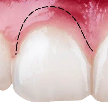 Contorno gingival que muestra los beneficios del alargamiento de corona dental