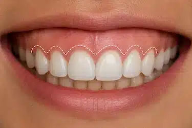 Exceso de encía en dientes superiores antes de un alargamiento coronario
