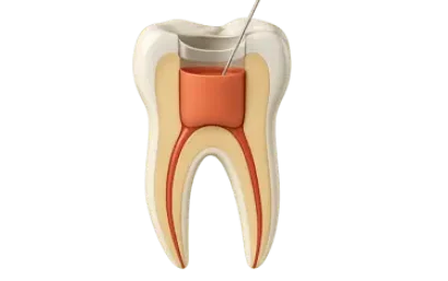 Endodoncia dental con limpieza del conducto radicular