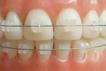 Brackets de zafiro transparentes en ortodoncia estética en Madrid con Clínica Dr. Ferrer