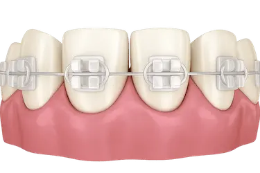 Brackets transparentes estéticos en dientes anteriores durante ortodoncia con el Dr. Ferrer