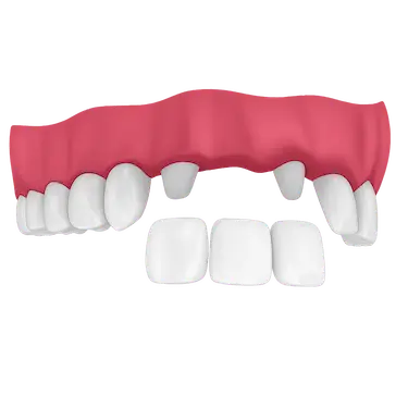 Puente dental de tres coronas colocado sobre dos dientes naturales previamente tallados