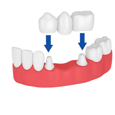 Puente dental tradicional de tres piezas sobre dientes pilares con póntico central