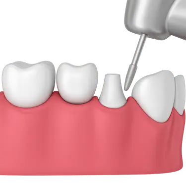 Tallado de un diente natural como preparación para colocar un puente dental fijo