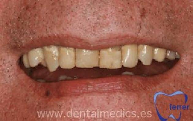 Antes