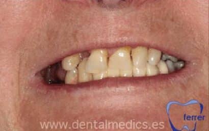 Antes