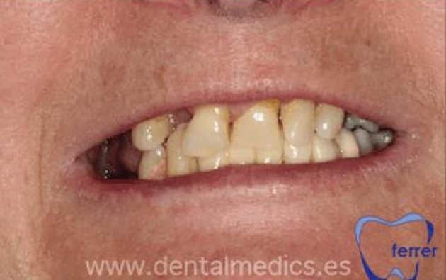 Antes