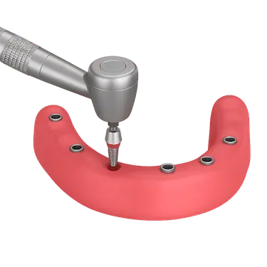 Cirugía de colocación de seis implantes dentales para prótesis híbrida fija