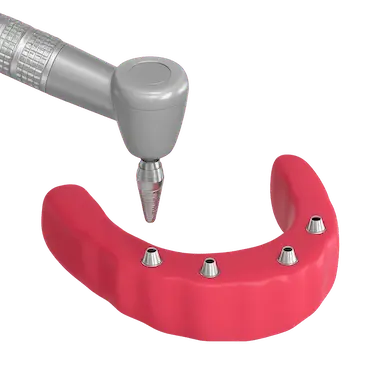 Cirugía para colocación de implantes dentales en tratamiento de sobredentadura por Dr. Ferrer