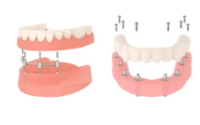 protesis dentales completas con implantes en Madrid Dr. Ferrer
