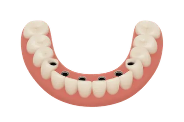 Prótesis híbrida sobre 6 implantes en arcada inferior en clínica dental del Dr. Ferrer en Madrid
