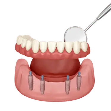 Revisión anual de sobredentadura inferior sobre implantes dentales