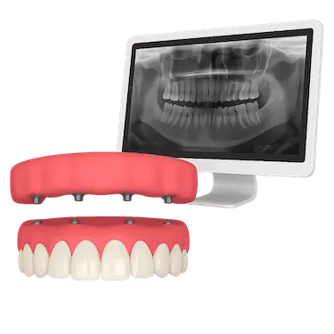 Monitor con imagen radiográfica para planificación de una prótesis híbrida sobre implantes