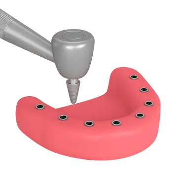 Modelo 3D del proceso quirúrgico de colocación de implantes dentales
