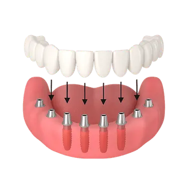 Arcada dental inferior con implantes listos para fijar prótesis definitiva