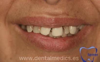 Antes