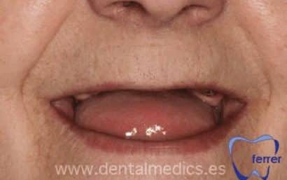Antes
