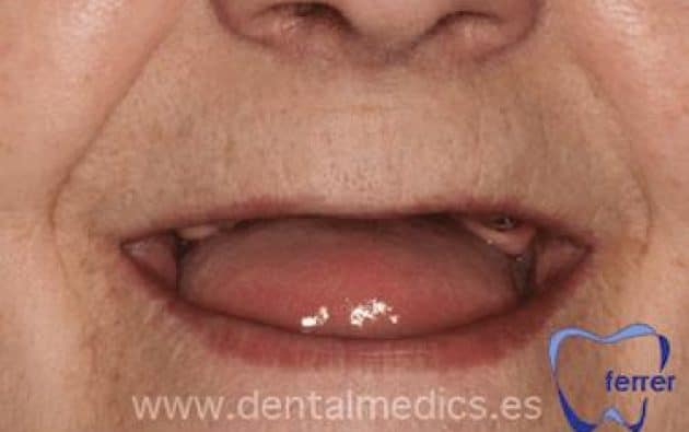 Antes