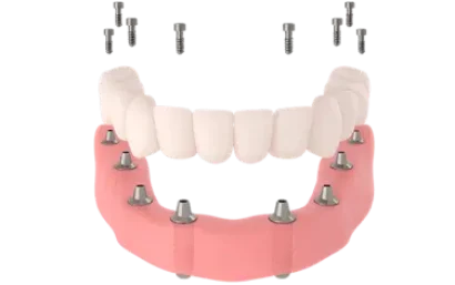 Dentadura postiza fija sobre implantes dentales en la clínica del Dr. Ferrer en Madrid