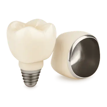Corona metal cerámica sobre implante dental con estructura metálica y recubrimiento estético