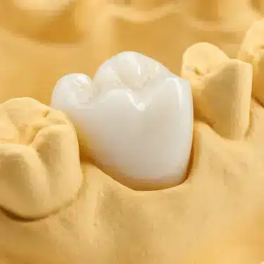 Modelo de laboratorio con corona provisional sobre implante dental