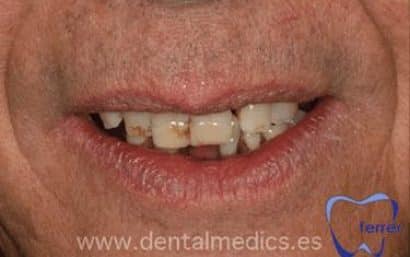 Antes