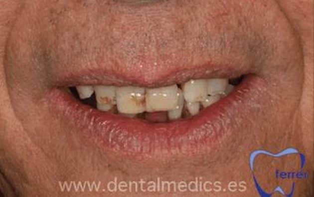 Antes