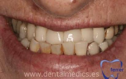 Antes