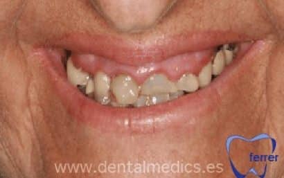 Antes