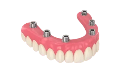 Prótesis dental híbrida sobre implantes en arcada inferior, tratamiento en Murcia con el Dr. Ferrer