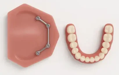 Prótesis removible completa con implantes en Murcia