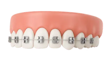 Arcada superior con brackets metálicos para corregir apiñamiento y alinear los dientes