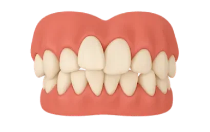 Maxilar superior 3D con dientes torcidos y colmillos desplazados por apiñamiento dental