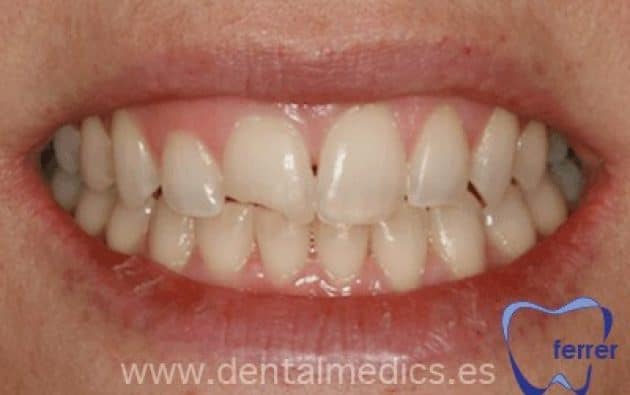 Antes