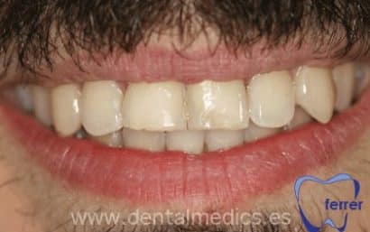 Antes