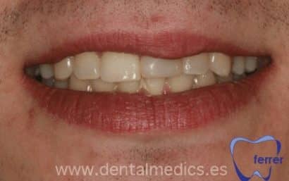 Antes