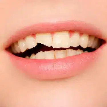 Diente frontal astillado por traumatismo, atendido de emergencia en clínica dental en Murcia