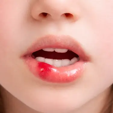 Labio inferior inflamado por golpe durante urgencia dental en Murcia