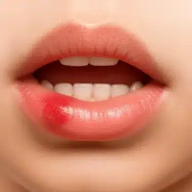 Herida inflamada en el labio inferior que requiere valoración en urgencia dental en Madrid