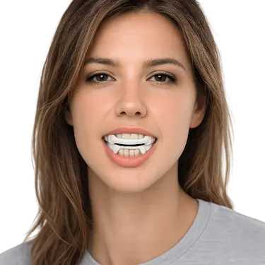 Paciente con dispositivo de avance mandibular OrthoApnea NOA para tratar ronquidos y apnea
