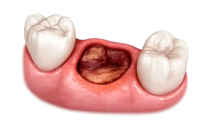 Alveolitis dental con alvéolo sin coágulo y hueso expuesto tras extracción